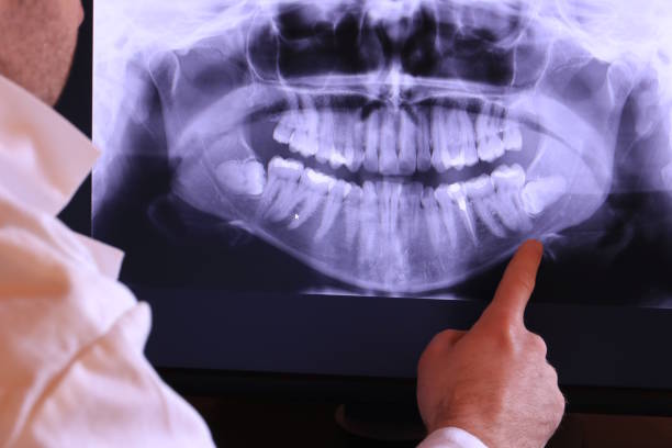 Best Emergency Wisdom Tooth Extraction in Ephrata, PA