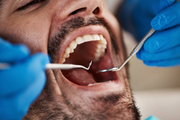 Best Emergency Wisdom Tooth Extraction in Ephrata, PA
